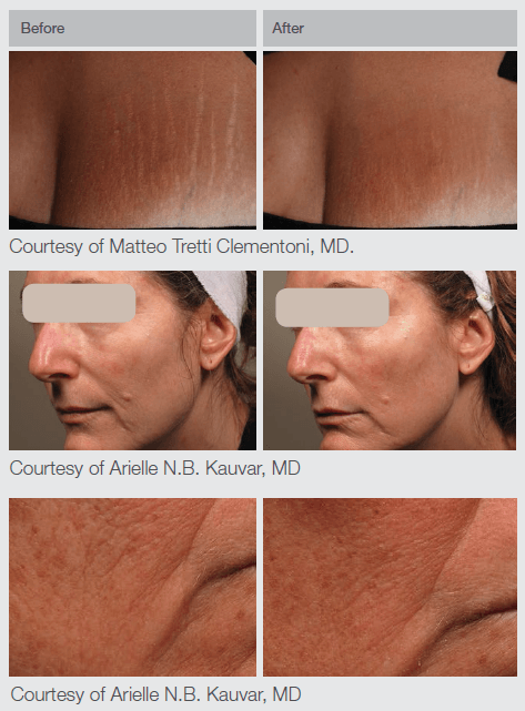 ResurFX-BA_New_2 ResurFX Before And After