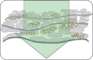 SLTIrradiation Representation of 400 micron SLT laser beam penetrating through TM