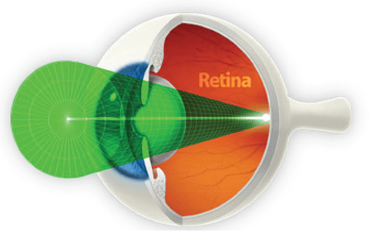 ss_New_1 Lumenis SureSpot technology