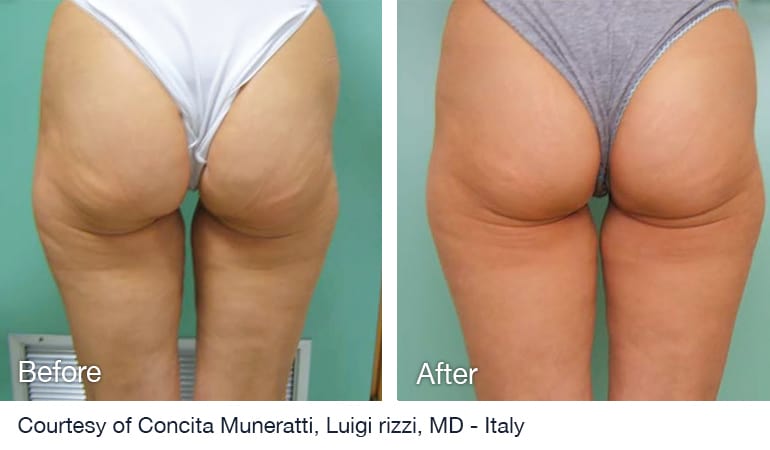 Before And After NuEra tight Skin Smoothing Treatment Before And After NuEra tight Skin Smoothing Treatment