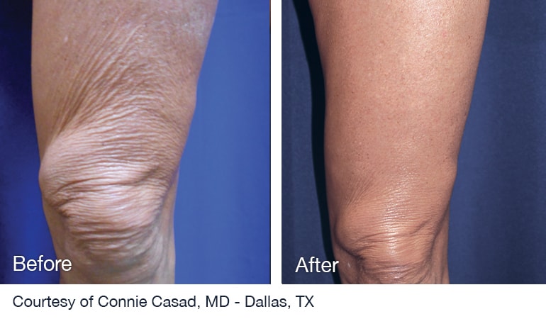 Before And After NuEra tight Skin Smoothing Treatment Before And After NuEra tight Skin Smoothing Treatment