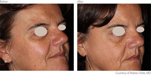 Before And After Non-Ablative procedure