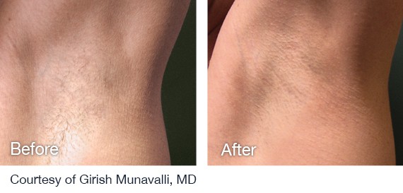 Laser Hair Removal Before And After Laser Hair Removal Before And After
