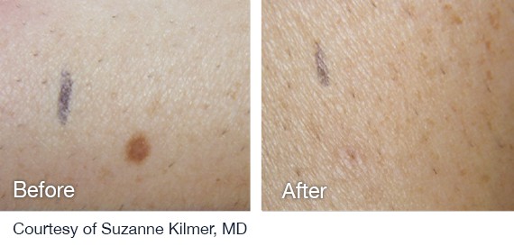 Laser Hair Removal Before And After Laser Hair Removal Before And After