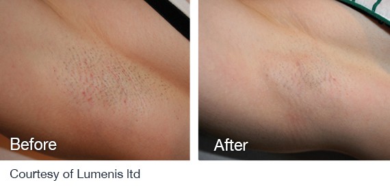 Laser Hair Removal before and after Laser Hair Removal before and after