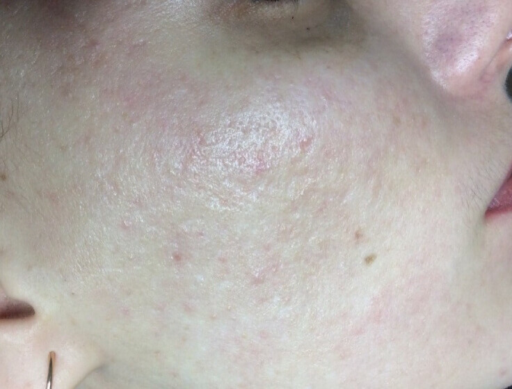 Before and After acne scars treatment