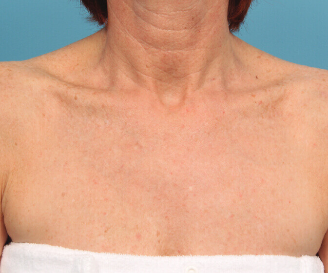 Before and After pigmentation treatment