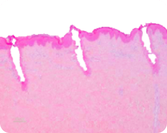 SuperPulse-mode SuperPulse fractional ablated spots histology