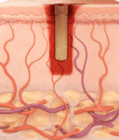 SuperPulse-pulse SuperPulse pulse profile illustration