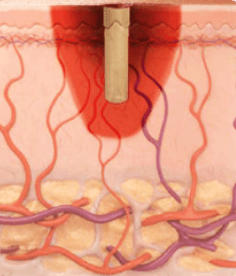 co2-continuous-wave-image2 Continuous Wave pulse profile illustration
