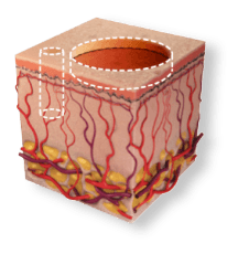 skin3 TotalFX - combination of ActiveFX and DeepFX pulse profiles