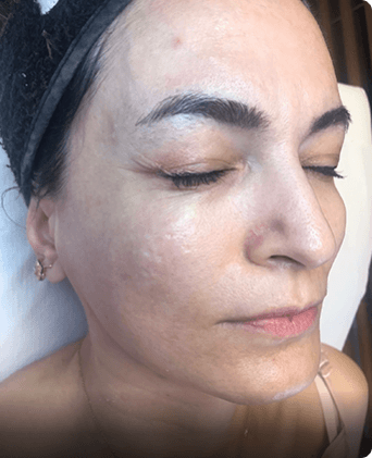 smoothglo treatment before and after