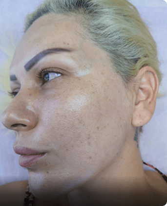 smoothglo treatment before and after