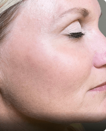 smoothglo treatment before and after