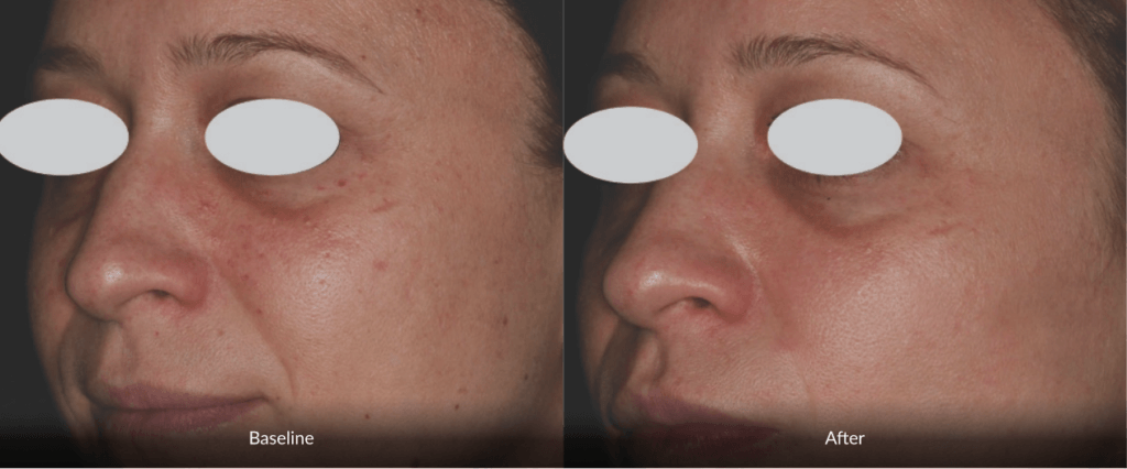 Before And After Photofabulous Treatment