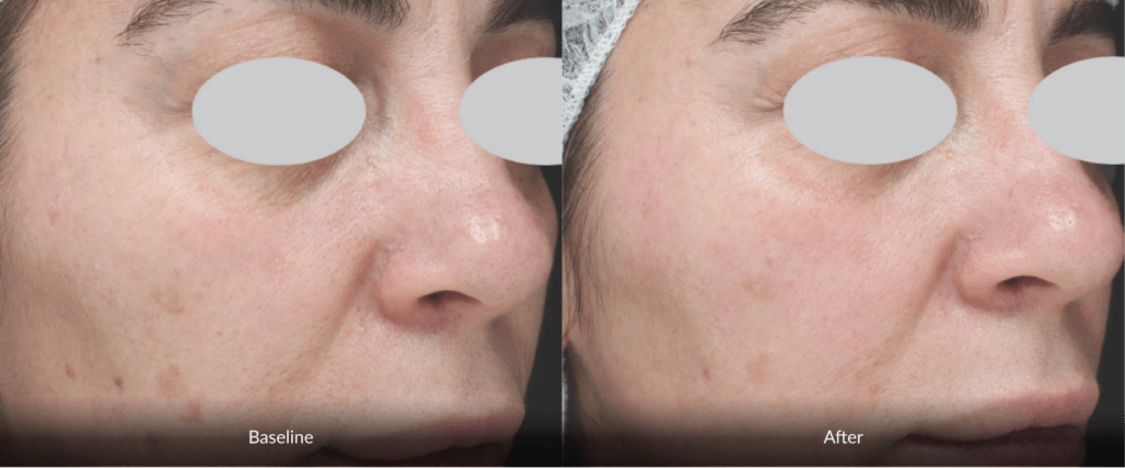 Before And After Photofabulous Treatment