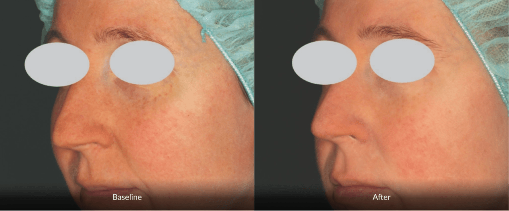 Before And After Photofabulous Treatment