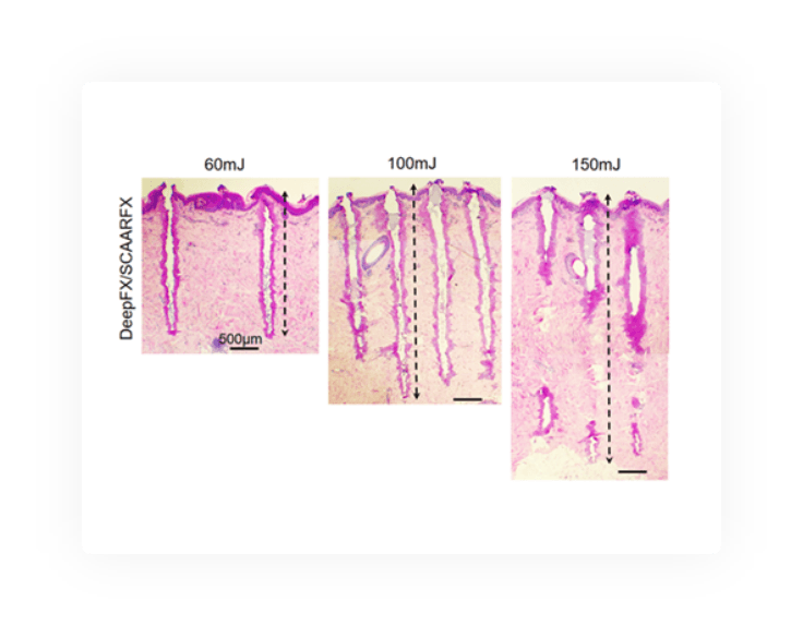 UltraPulse Alpha penetration depth.