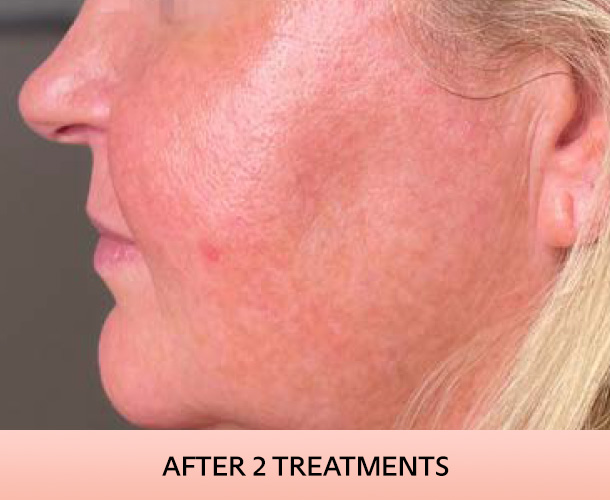 Cheekbones after triLift treatment