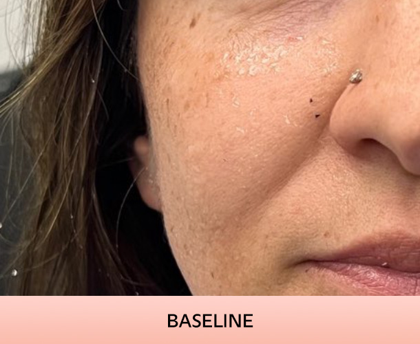 Cheekbones before triLift treatment