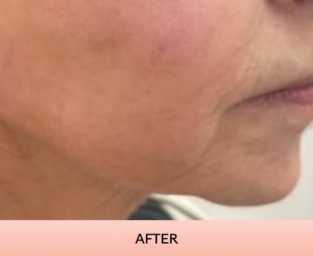 Jawline after triLift treatment