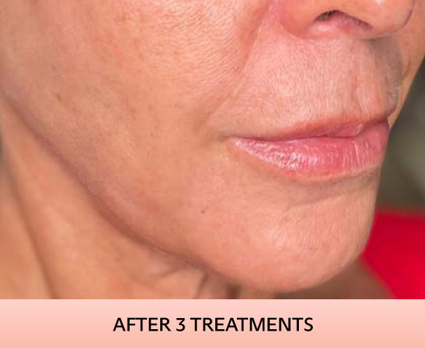 Jawline after triLift treatment