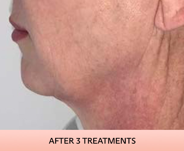 Jawline after triLift treatment