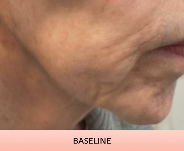 Jawline before triLift treatment