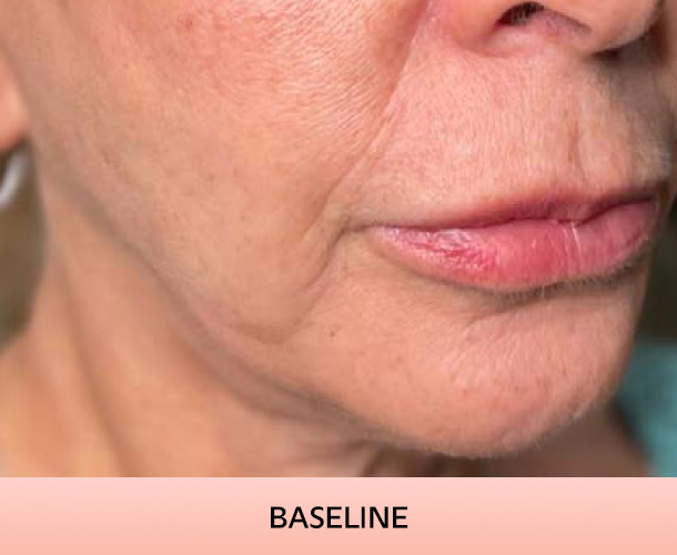 Jawline before triLift treatment