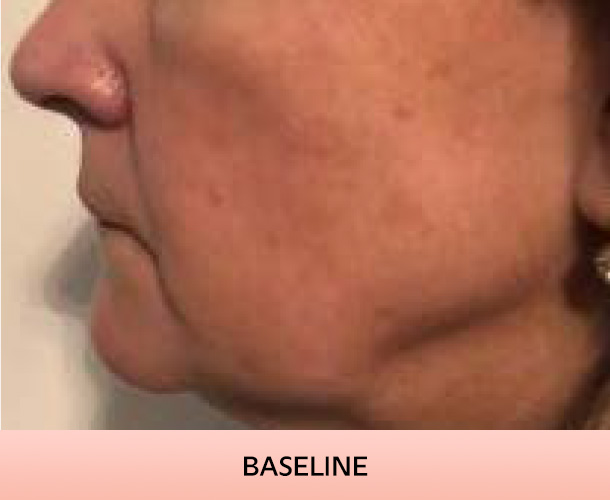 Jawline before triLift treatment