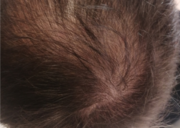 FoLix hair loss treatment before and after photos